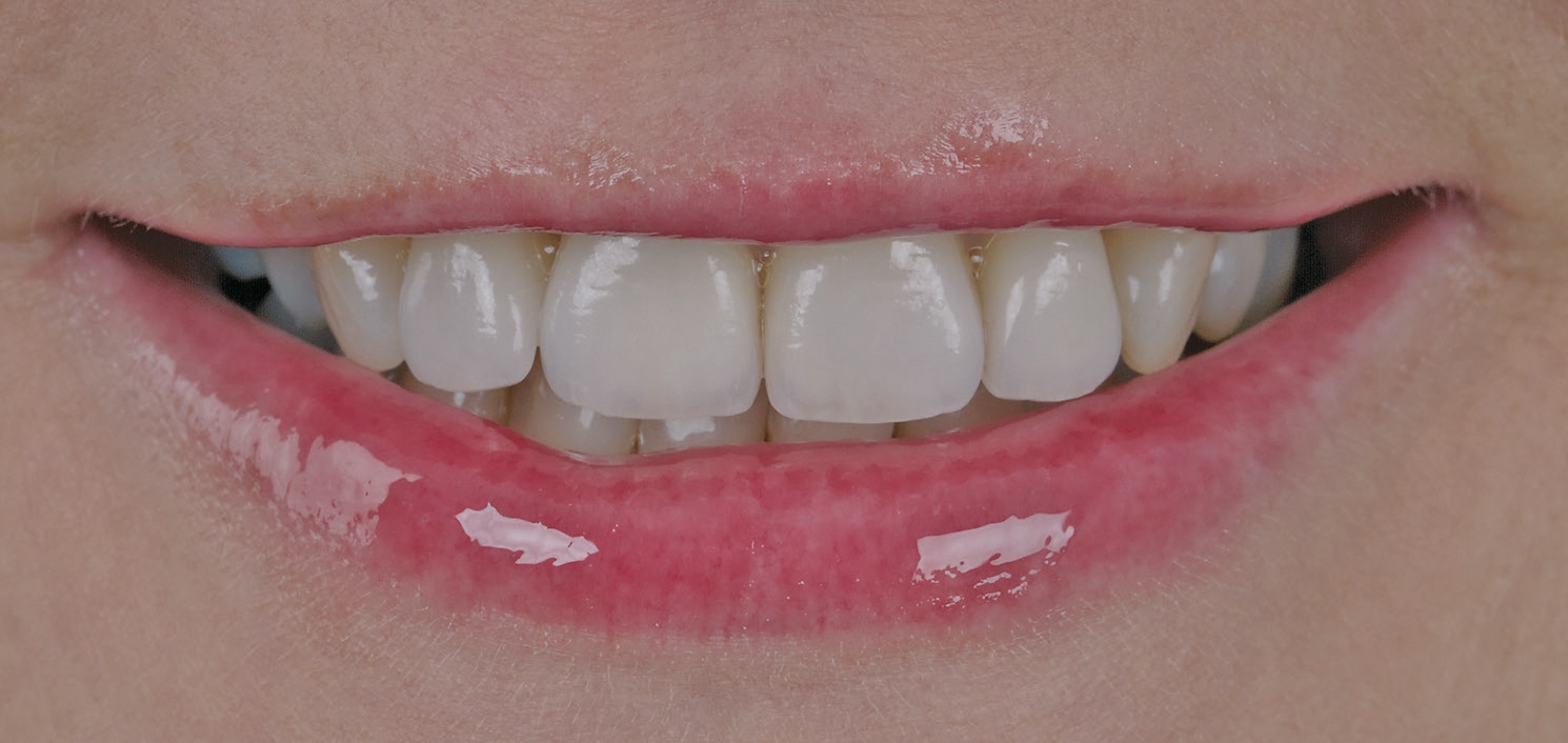 Abb. 9: Neuer Zahnersatz im Lippenbild, frontal ...