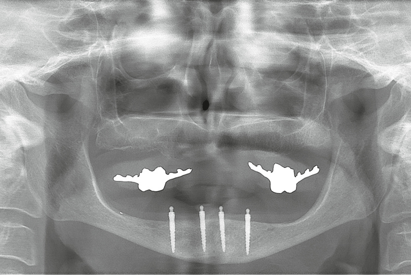 Abb. 9: Abschließendes Röntgenbild. Vier CITO mini®-Implantate im Unterkiefer geben dem Zahnersatz seinen notwendigen Halt.