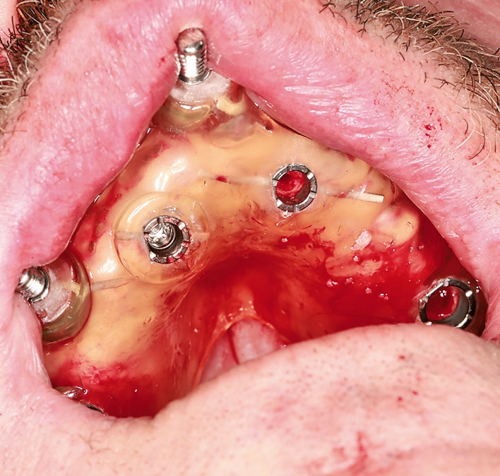 Abb. 9: Die Schablone im Oberkiefer eingesetzt und mit den mitgelieferten Pins an drei Positionen fixiert.