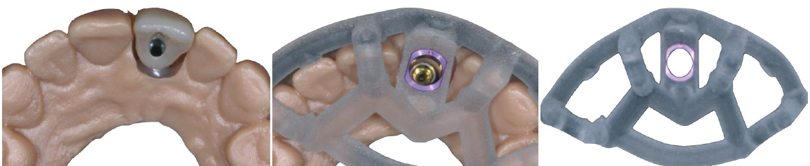 Abb. 9: Die Bohrschablone wurde im 3-D-Drucker angefertigt.