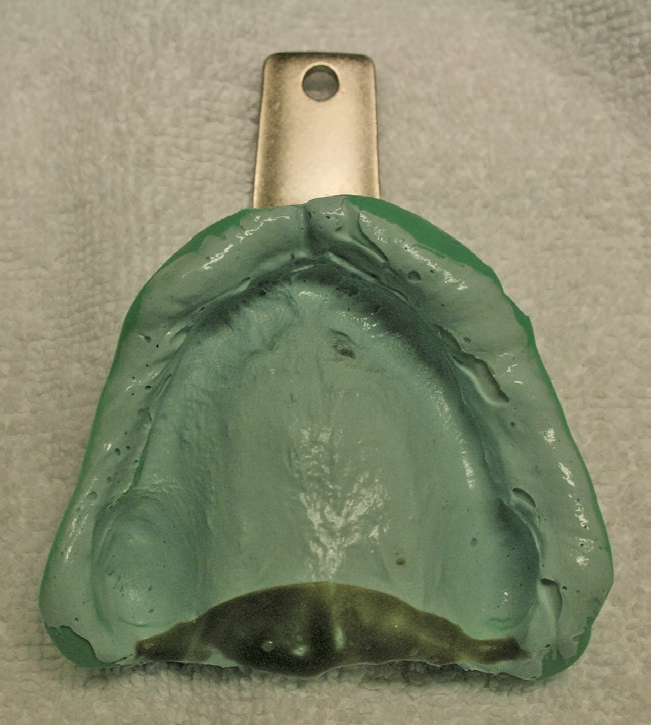 Abb. 4b: Anatomische Abformung des Oberkiefers.