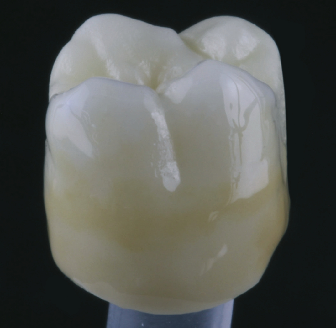 Abb. 9: Die fertige mit HeraCeram Stains universal individualisierte Seitenzahnkrone.