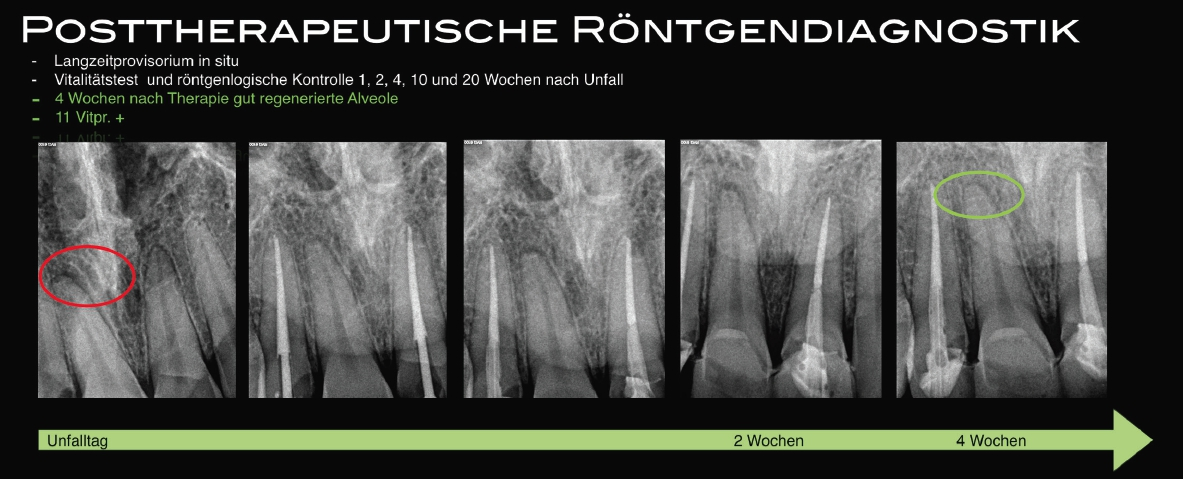 Abb. 11: Posttherapeutische Röntgendiagnostik.