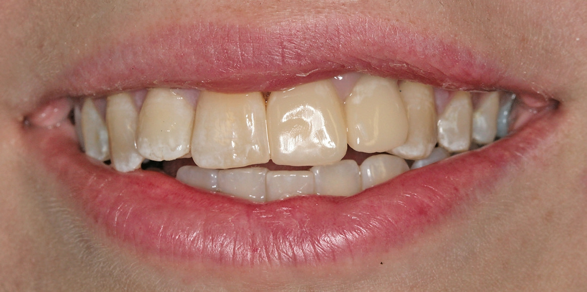 Abb. 9: Blick von extraoral auf das Provisorium.