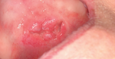 Abb. 9: Ulzerierende Läsion des harten Gaumens. Zunächst erfolgte der Ausschluss eines traumatischen Ulkus. Bei Persistenz über 14 Tage ist dieser Befund hochgradig tumorverdächtig.