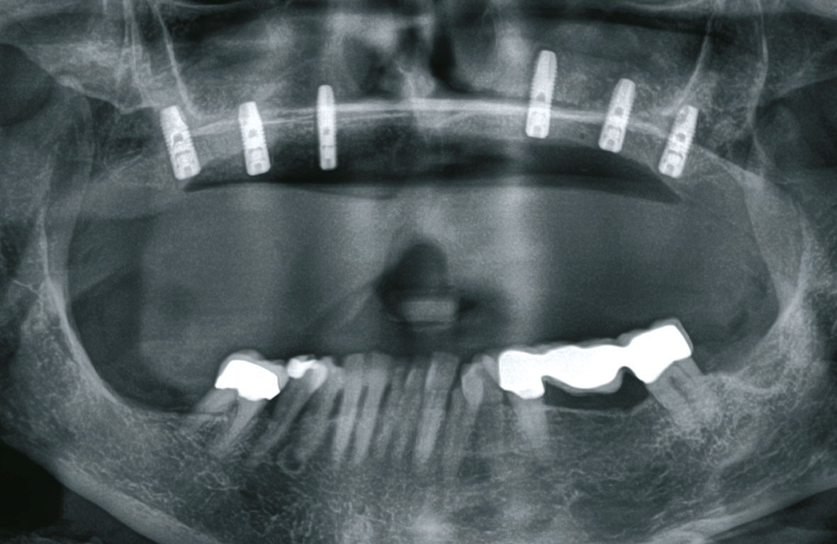 Abb. 8: Das postoperative Röntgenbild zeigt die 6 inserierten Implantate im Oberkiefer.