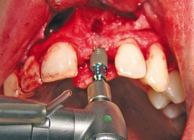 Abb. 7: Im ersten Schritt wurde das Implantat inseriert.