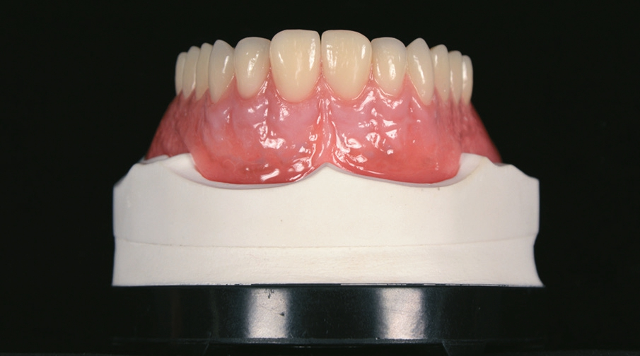 Abb. 9: Ergebnis: Die natürlichen Gingivaanteile konnten rationell rekonstruiert werden. Das finale Ergebnis zeigt die Harmonie zwischen roter und weißer Ästhetik.