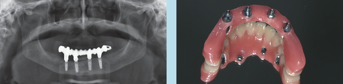 Abb. 7 u. 8: Gefräste Primärkonstruktion (Steg) und Verblendung mit Kunststoffzähnen und Basiskunststoff direkt auf Implantatniveau verschraubt.