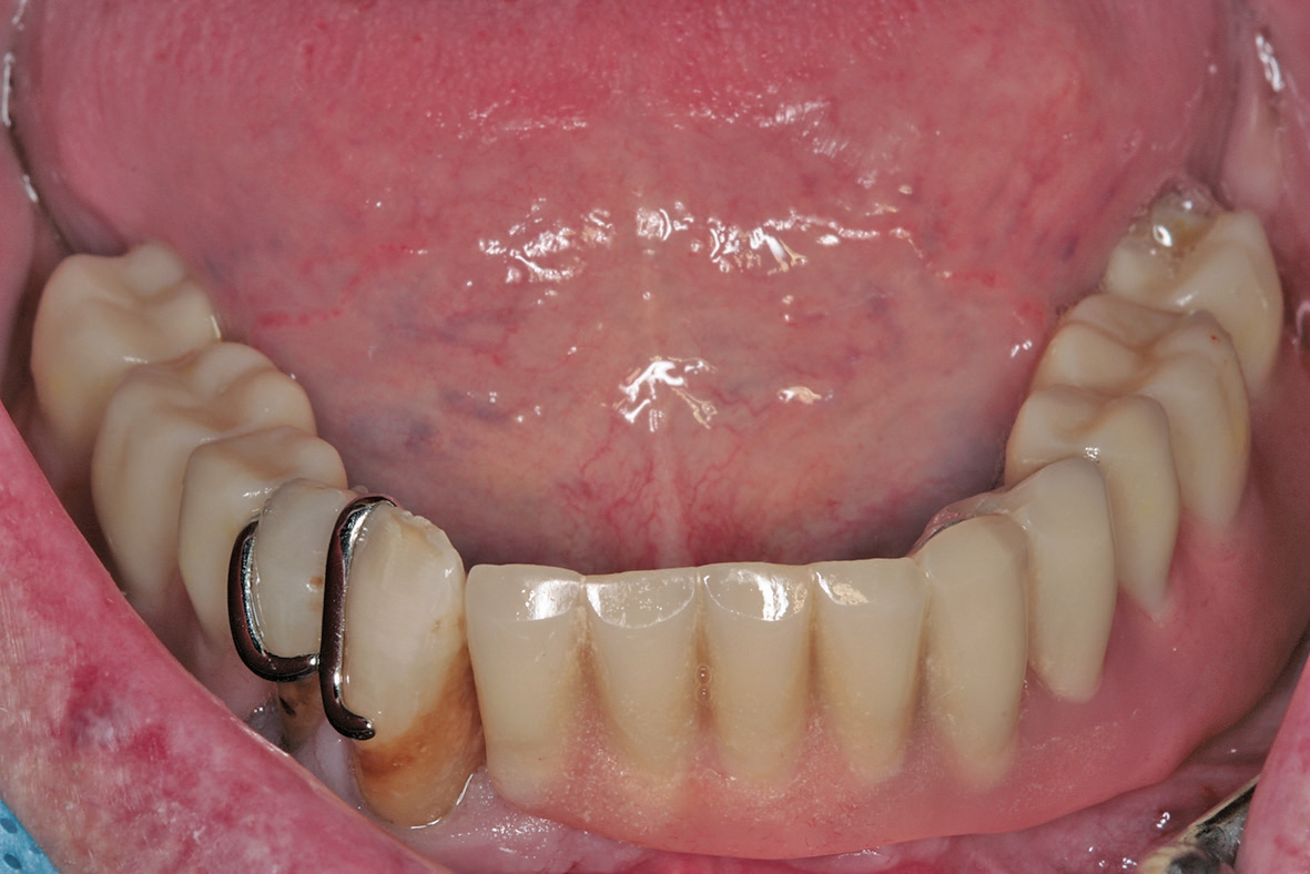 Abb. 9a: Ausgangssituation mit bisherigem Prothesenzahnersatz in situ.
