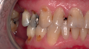 Abb. 9: Mischform von sich überlagernden, destruktiv ergänzenden Zahnabnutzungen. Sie erkennen, welche das sind?