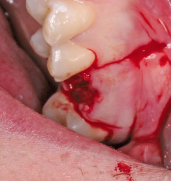 Abb. 9: Vertikale Entlastungsschnitte mesial und distal der Extraktionsalveole.