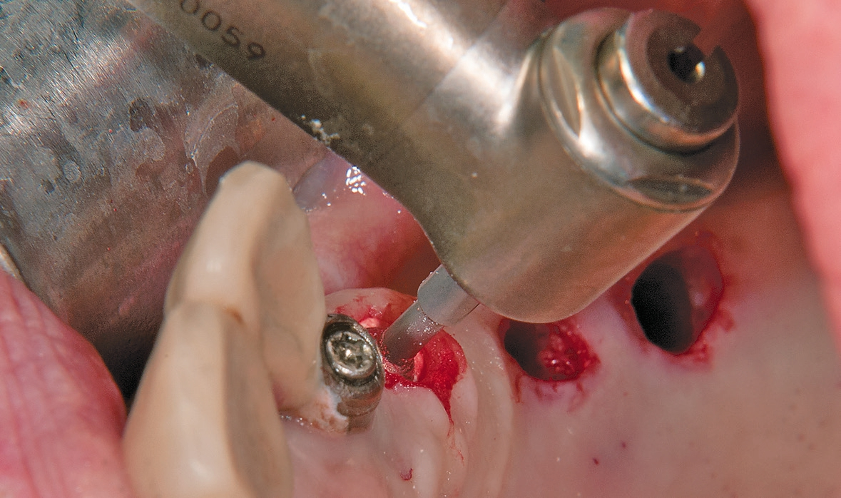 Abb. 9: Nach Gewindeschneiden, Einbringen des Implantats.