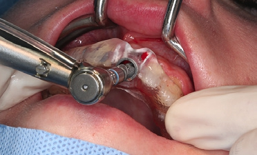 Abb. 8: Aufbereiten des Implantatbetts nach Astra Bohrprotokoll, Insertion des Astra EV 4,8 x 15C bei Anwendung der SICAT Bohrschablone.