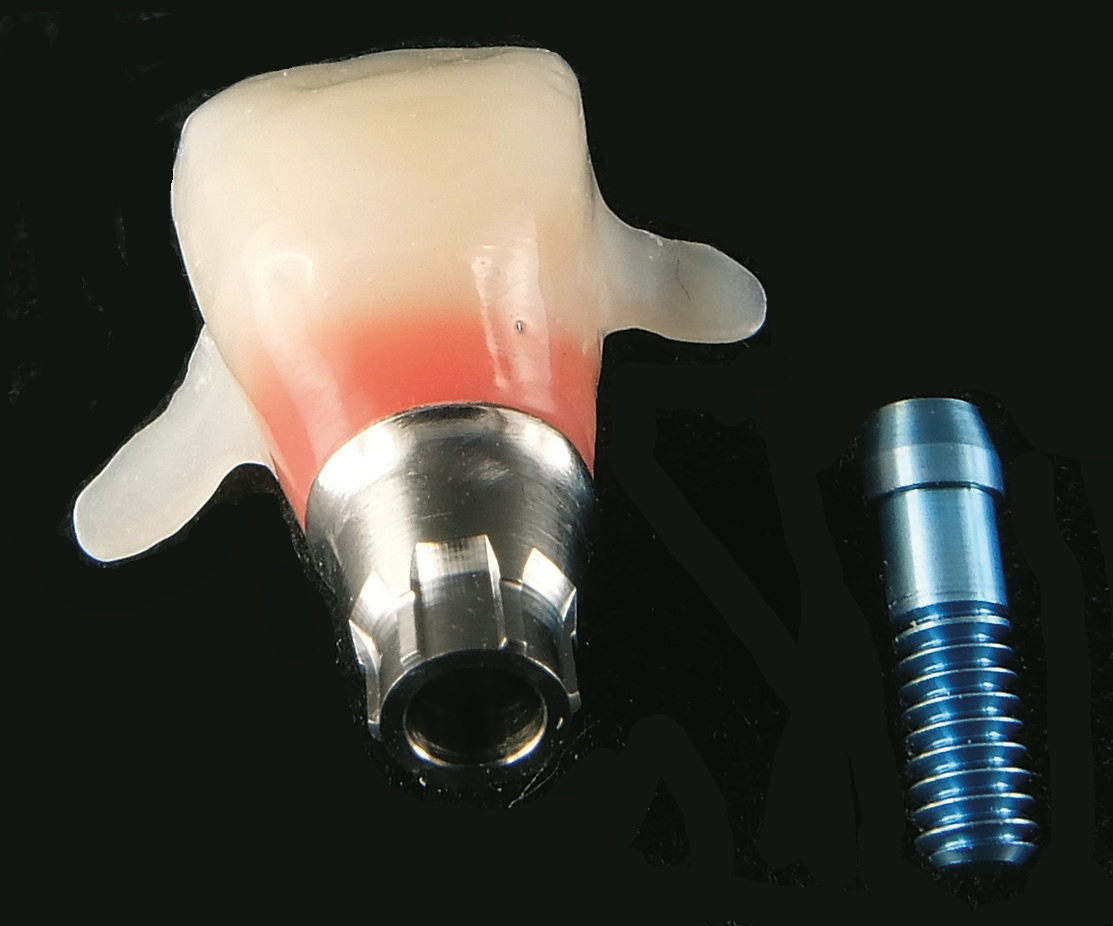 Abb. 18: Die provisorische Krone – mit kleinen Flügeln zur Entlastung des Implantats.
