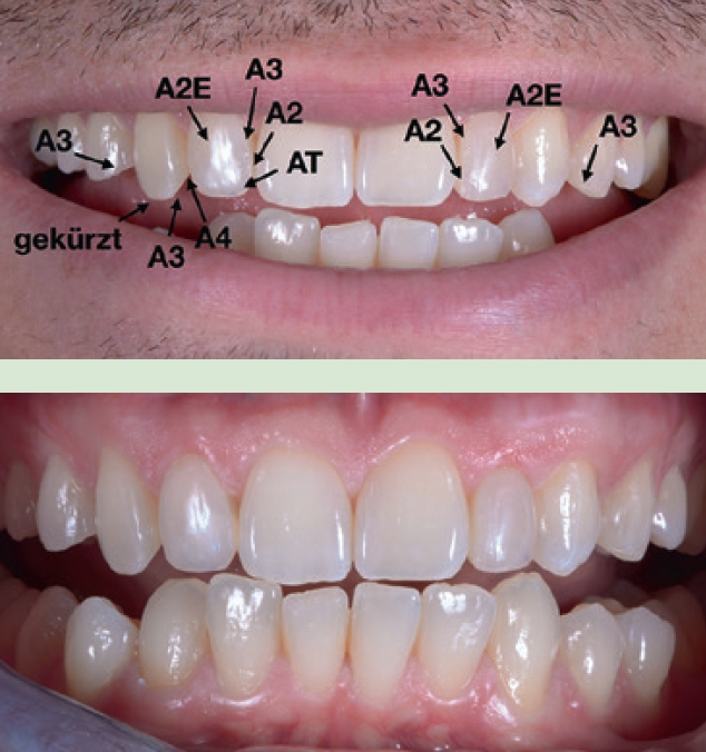 Abb. 9 a und b: Farbliche Gestaltung der Komposit-Restaurationen.