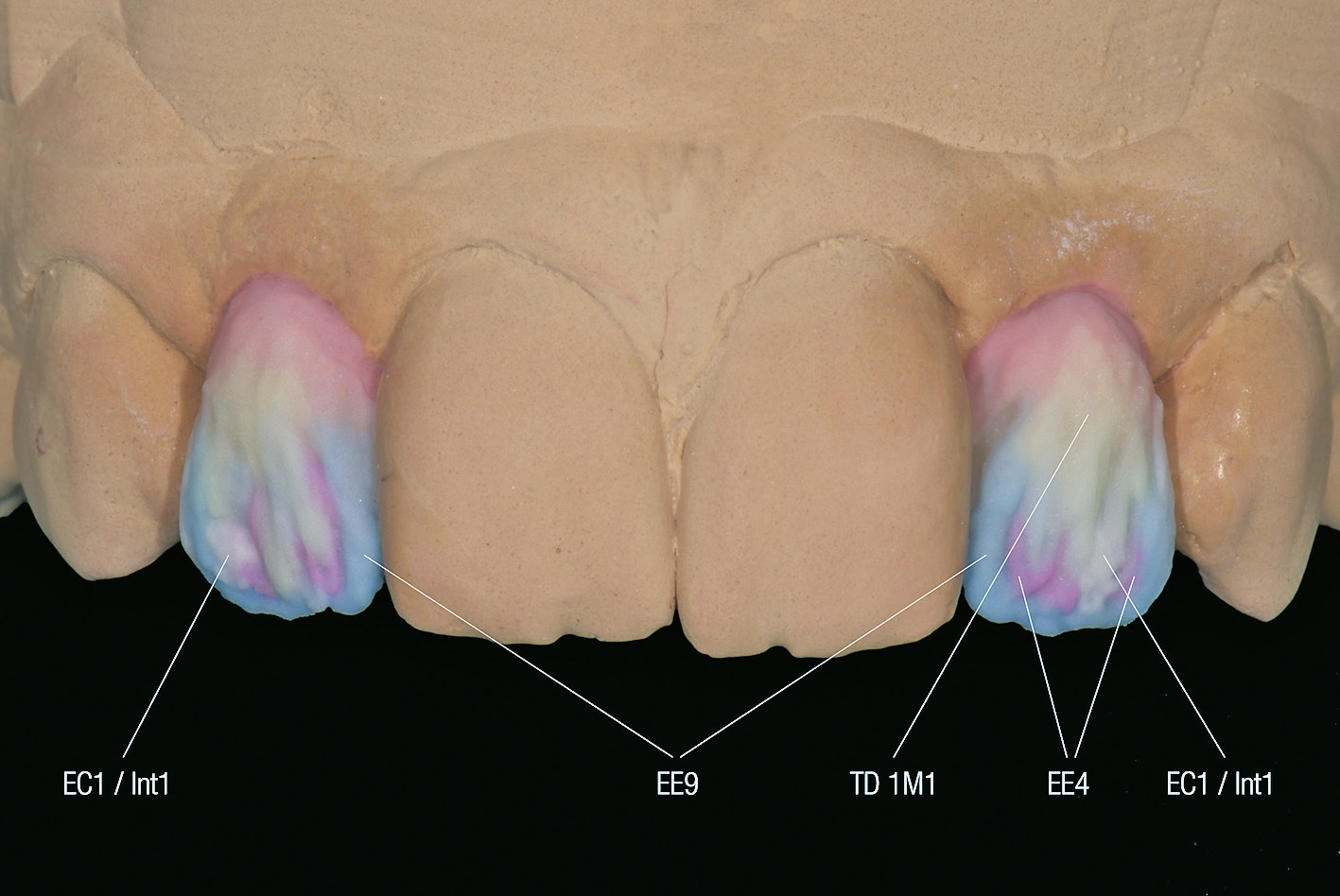 Abb. 9: Auftrag der zweiten Schicht vor dem ersten Dentinbrand.