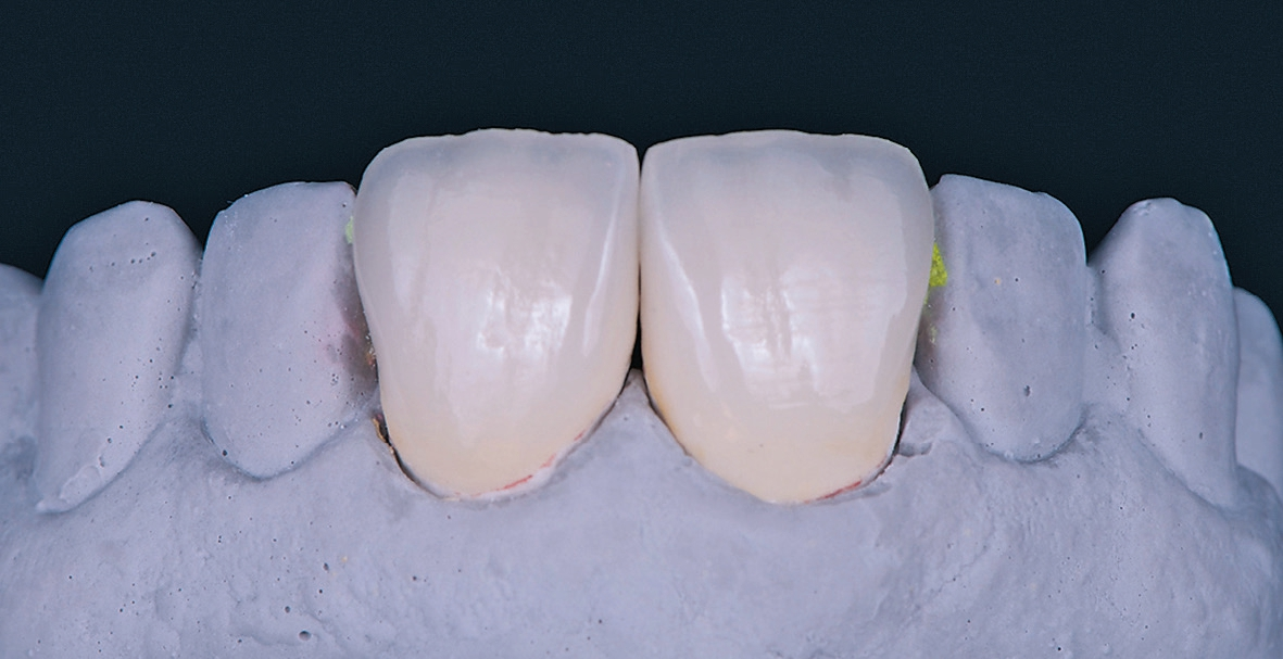 Abb. 10: Die Veneers mit hoher Lichtdynamik auf dem Modell.