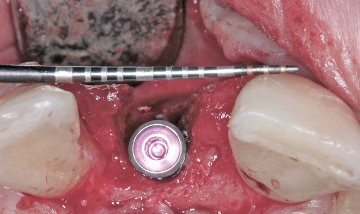 Abb. 9: Entsprechend der Tarnow Regel wurde der Abstand von 1,5 bis 2 mm zwischen Implantat und Zahn eingehalten.