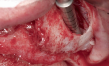 Abb. 9: Brechen des Septums mittels Osteotom.