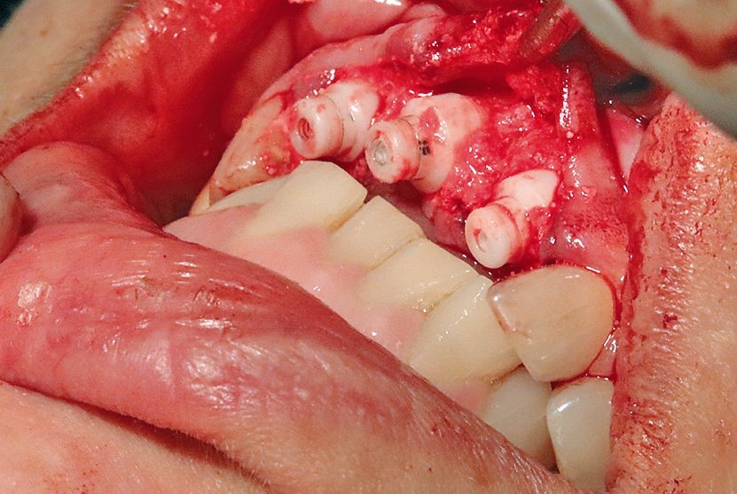 Abb. 10: Insertion von drei einteiligen Keramikimplantaten zentral in die Alveolen.