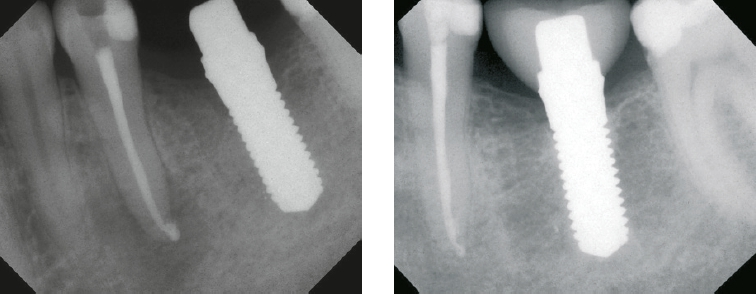 Abb. 13 und 14: Ein ø 4,5 mm einteiliges BioWin! als verzögertes Sofortimplantat regio 36 (bei gleichzeitiger Endo-Revision des Zahnes 35) und röntgenologischer 5-Jahres Kontrolle!