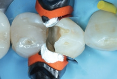 Abb. 9: Teilmatrizensystem mit individualisiertem 3D-Ring.