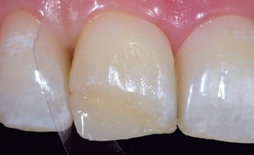 Abb. 9: Als Vorbereitung vor dem Auftragen einer weiteren Schicht des opaken Komposits (Venus Diamond, OMC, Kulzer) wird im Interdentalraum ein Klarsichtstreifen (Epitex, GC) positioniert, um die distale Kontur gestalten zu können. Die Gestaltung der distalen Kontur erfolgt durch Materialauftrag an den Streifen und durch dessen Zug nach palatinal mit gleichzeitiger Krümmung nach vestibulär.