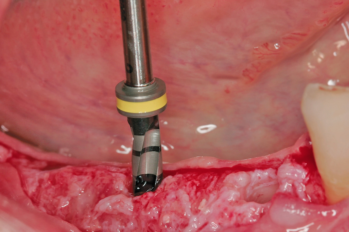 Abb. 11: Nach Bestimmung der geeigneten Implantatpositionen wurden drei Implantate gesetzt.