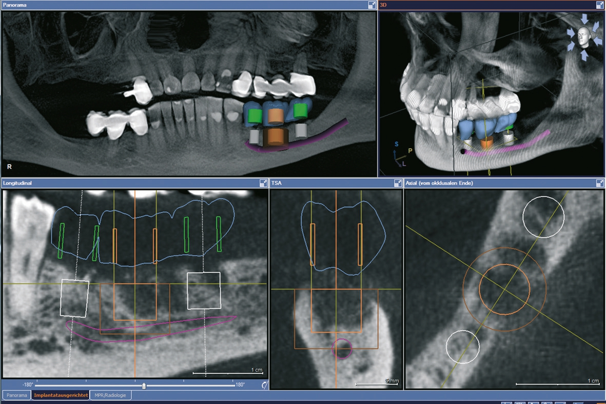 Abb. 9: Implantatplanung für drei ultrakurze Implantate bei reduziertem vertikalen Knochenangebot.