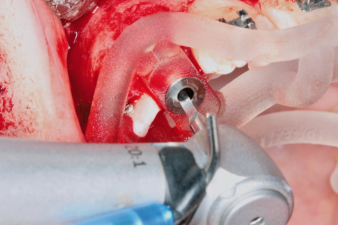 Abb. 10: Insertion der Implantate mit Hilfe einer Schablone in regio 12 und 22.