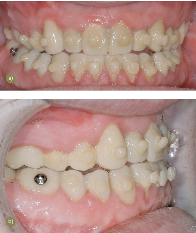 Abb. 9: Zustand nach einjähriger Tragezeit vor der geplanten Entfernung der Osteosyntheseplatten. a) Frontalansicht mit angebrachten Brackets zum Einhängen von Gummizügen gegen das Auftreten eines Frührezidivs. Aufgrund der mangelnden häuslichen Mundhygiene stellt sich eine gereizte und gerötete Gingiva dar. b) Rechte Seitenansicht.