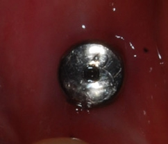 Abb. 13: Versorgung des Implantats mit einem Gingivaformer.