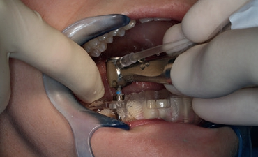 Abb. 9: Implantatbett-Präparation durch die Bohrschablone.