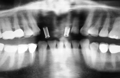 Abb. 9: Kontrolle der Implantatposition mit Bohrschablone mittels OPG.