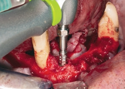 Abb. 9: Implantatinsertion regio 42.
