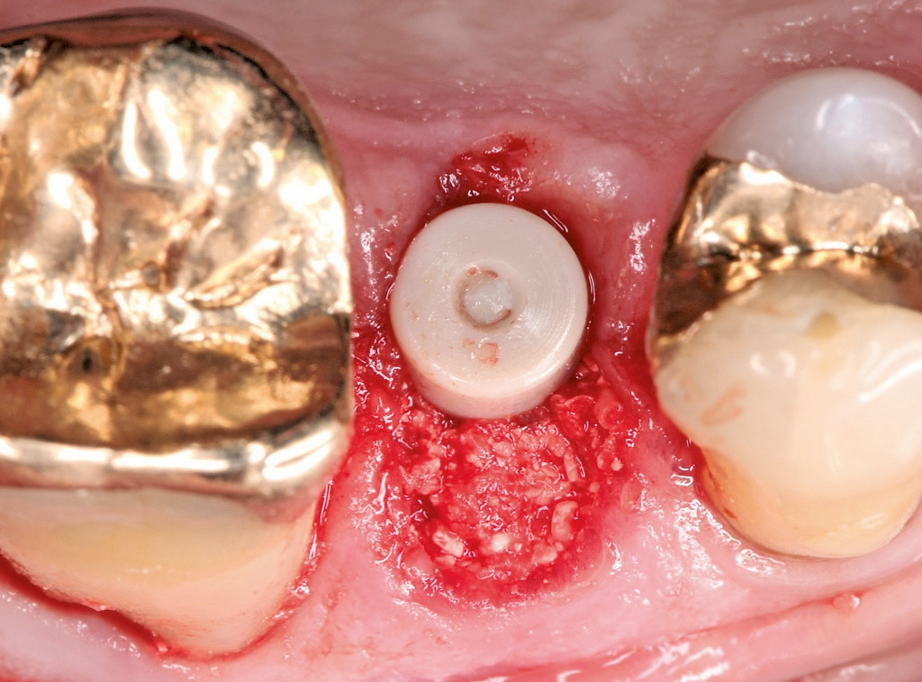 Abb. 10: Mit dem Gemisch aufgefüllter Spalt zwischen Implantat und bukkaler Knochenwand.