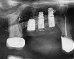 Abb. 13: Postoperatives Röntgenbild der ossären Augmentation mittels titanverstärkter Membran.