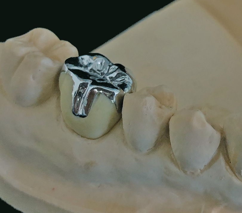 Abb. 13: Im Fokus: das Inlay auf Zahn 46.