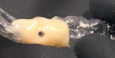 Abb. 10: Die umgearbeitete Implantat-Bohrschablone trägt den Schraubenkanal. Damit kann die Abutmentschraube erreicht und eine Schraubenlockerung bei Bedarf behoben werden.