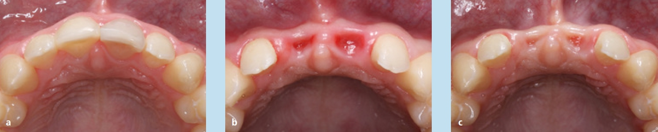 Abb. 7a–c: Extraalveolärer Prozess mit lateraler Atrophie nach 6 und 12 Wochen.