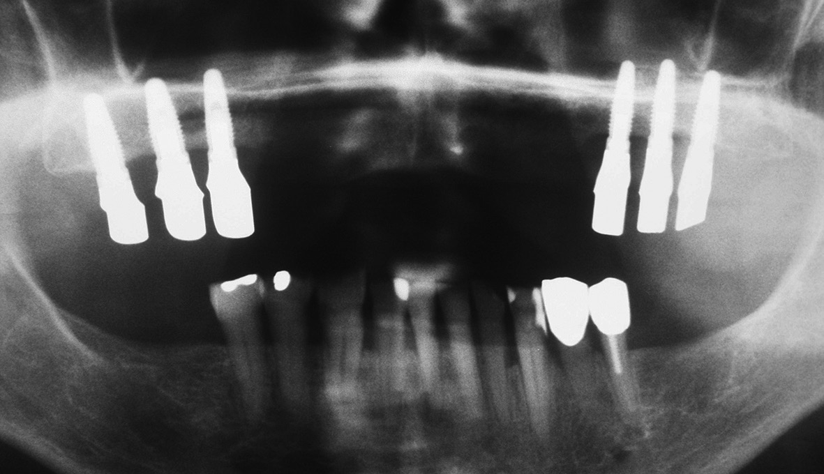 Abb. 7: Im OPG wird sichtbar: Der Zahn 35 war endodontisch behandelt.