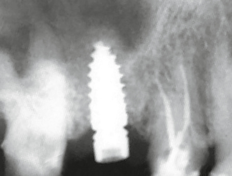 Abb. 11: Titan (R)Evolution Implantat.
