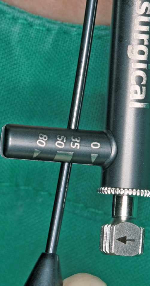 Abb. 8: Primärstabilität über 35 Ncm.
