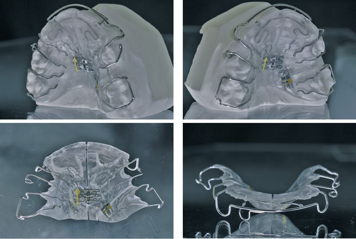 Abb. 9a–d: Verschiedene Ansichten der erarbeiteten Dehnplatte.