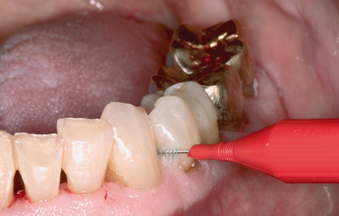 Abb. 8: Die häusliche Interdentalraumpflege sollte im Zuge der Vorbehandlung mit dem Patienten geübt werden.