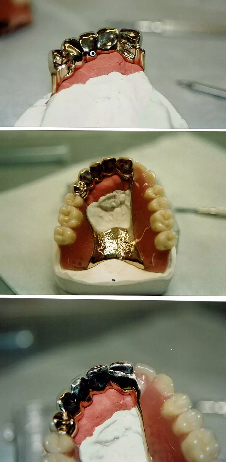 Abb.1: Januar 1999 – OK-Versorgung aus verschraubter, kompositverblendeter Geschiebebrücke auf Implantaten mit Modellgussbügel aus Edelmetall.