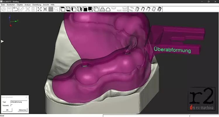 Abb. 10: Digitale Konstruktion einer Überabformung.