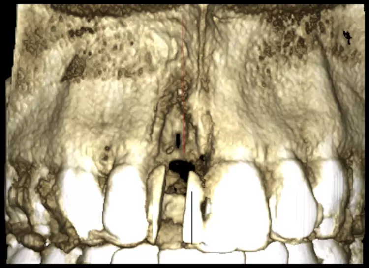 Abb. 10: Frontalansicht im DVT mit Bohrschablone und sichtbarem bukkalen
Knochenfenster.