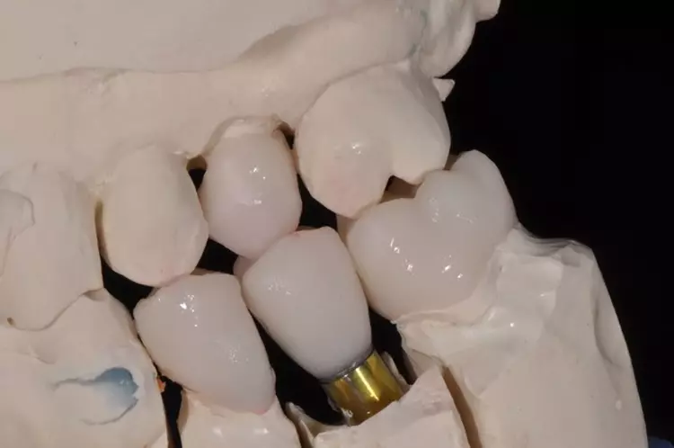 Abb.10: Herstellung der Emax-Implantatkronen (Multilink Hybrid Abutment,
Ivoclar) Titanbasis (Nobel Universal Base RP, Nobel Biocare) auf dem Modell.